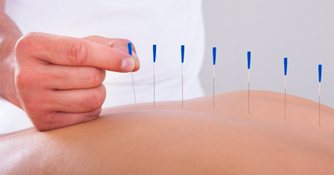 acupuncture therapy
