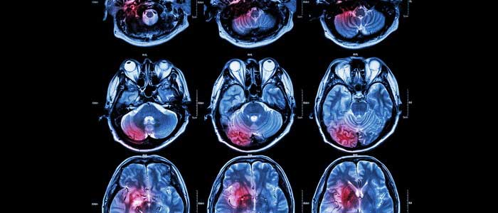 MRI of human brain