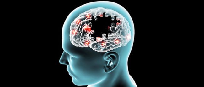 brain with Alzheimer's disease scan