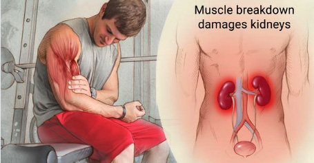 rhabdomyolysis