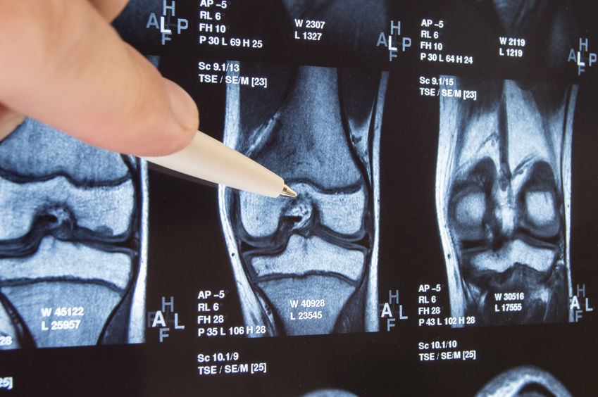 SHR # 2397 :: The Pep Talk: Treating Osteoarthritis - Beyond Stem Cells &amp; PRP