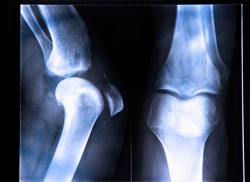 New Hope for ACL Injuries PLUS GHRP6 to Cure GERD