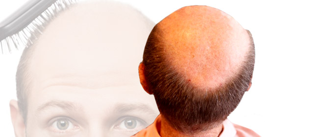 a bald head