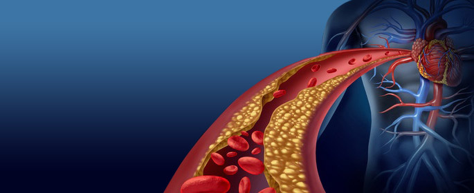 Clogged artery and atherosclerosis disease