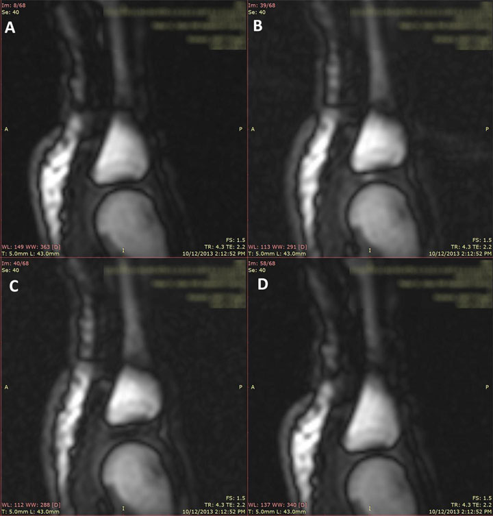 This image shows the right 4th MCP joint in the resting phase (A). This image shows the MCP joint as seen during distraction of the MCP joint in the frame just prior to joint cracking / joint separation (B). The MCP joint visualized in the next frame immediately after joint cracking (C). This image shows the joint in the refractory phase immediately after removal of distraction forces (D).