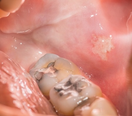 mercury filled tooth