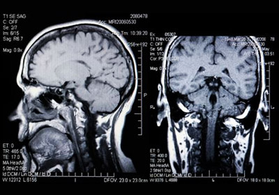 MRI scans of head and brain
